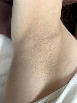 エルミューノ(elμno)/ワキ脱毛 ビフォー