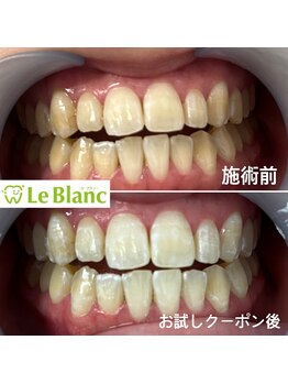 ルブラン 奈良店(Le Blanc)/2回でトーンup