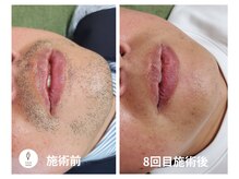 ヴォアール 名古屋店(VOIR)の雰囲気（最新LED脱毛でコスパ◎青い濃いヒゲ、カミソリ負けにサヨウナラ）