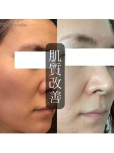 ディオーネ 麻布十番(Dione)/【ハーブピーリング】