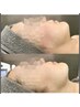 【小顔矯正リフトNo.1】『瞬間リフトアップ』小顔リフト3層+脂肪分解 5000発