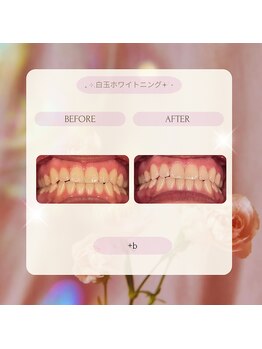 プラスビー 2号店(+b)/ホワイトニングビフォーアフター