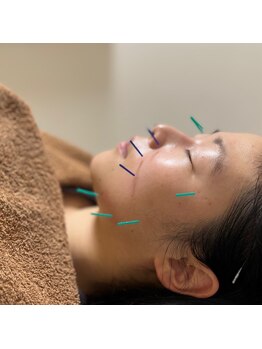 あとらす整体院 小岩店/美容鍼施術中。