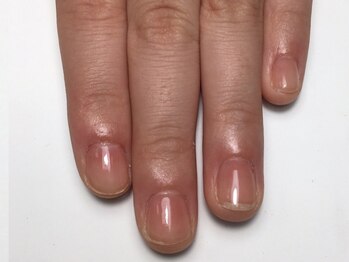 メテ(mete)/《深爪緩和》