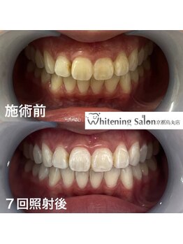 ホワイトニングサロン 京都烏丸店/ホワイトニング施術例
