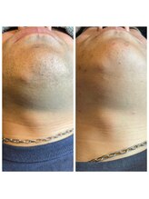 ココリ(CoCoRe)/髭光脱毛