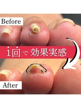 巻き爪矯正センター 沖縄 宜野湾/巻き爪矯正ビフォーアフター