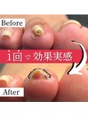巻き爪矯正ビフォーアフター