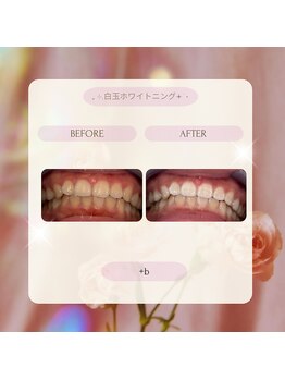 プラスビー 2号店(+b)/ホワイトニングビフォーアフター