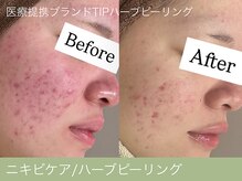 オーエン 小倉店(o-eN)/ニキビケア/ハーブピーリング