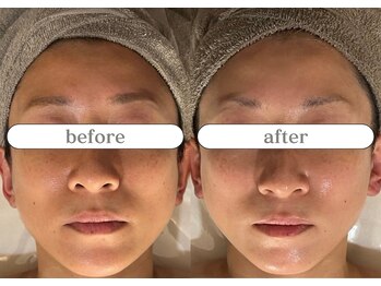 リスタ(RSTA)/【BEFORE/AFTER】