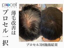 レイ(Rey)の雰囲気（頭皮環境を整えることが太い毛を育てます。プロセル頭皮ケア開始）