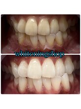 ホワイトニングショップ 三田店/before after