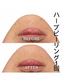 スピード美人 新宿店/ハーブピーリング顔