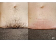 ムート(Mut.)/メンズ脱毛／VIO