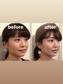 隆鼻矯正専門店 ラプリ(Raplit) 隆鼻+輪郭矯正40分10回#美鼻#小顔#小顔矯正