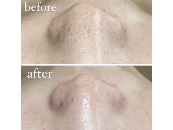 オルネ(ORNE.)/《毛穴洗浄スタンダード》