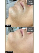 クレヴィー(Creviy)/ヒゲ脱毛4回照射