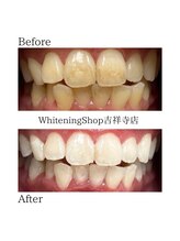 ホワイトニングショップ 吉祥寺店/【ビフォーアフター】