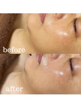 デジール(desir)/【フェイシャル】before/after