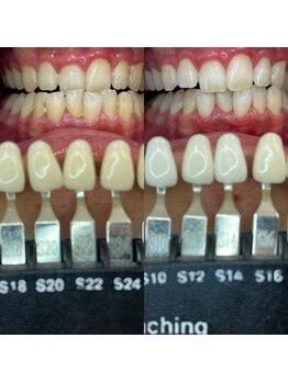 トウキョウスワーズ 池袋店(TOKYO SWRS)/#ホワイトニング #池袋 #渋谷