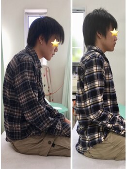 こころ整骨院 こころ鍼灸院/猫背矯正 Befor After