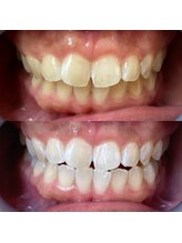 ワールドビューティー(World Beauty)/2週間のBefore After