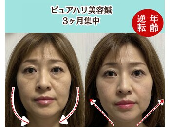 ピュアハリ/沖縄那覇美容鍼灸/たるみ/小顔