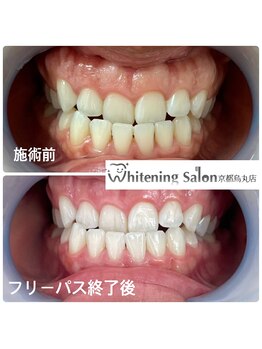 ホワイトニングサロン 京都烏丸店/ホワイトニング施術例