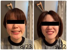 スターエステ(STAR ESTHE)/小顔矯正＋小顔ハイパーナイフ