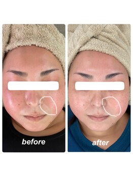 ヴィーナス(Venus)/ヒト幹細胞フェイシャルエステ