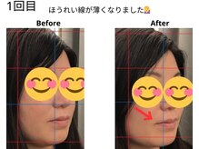 ベル/30代の方の小顔Before After