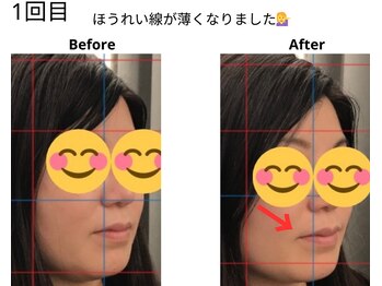 ベル/30代の方の小顔Before After