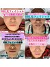 男女OK!《初回・BBLフェイシャル》シミ改善・シワ改善・ニキビケア★¥6,600→