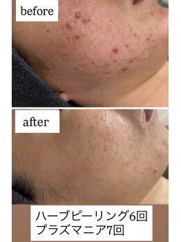 アヌヘア(Anuhea)/剥離しないハーブピーリング