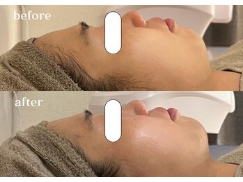 リスタ(RSTA)/【BEFORE/AFTER】