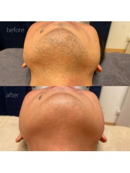 オンセ(once)/顔脱毛/全身脱毛