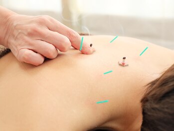 マチコ鍼灸院/おきゅうをします