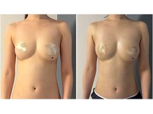 モア(moa)/バストケア3回目