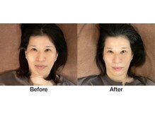 こじま 富雄団地接骨院/頬のハリ感UP！