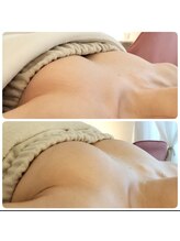 アンドモア(&more)/バストアップ症例