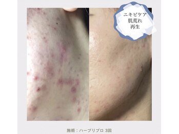 ノイ(Noi)/【ニキビケア】本気の肌質改善