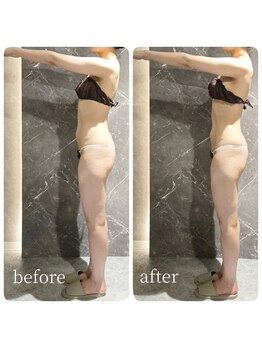 インディバ 六本木/【背中腰腹部上半身集中】痩身