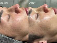 ルミナ シブヤ(LUMINA SHIBUYA)/【ダクトピール】1回目　横顔