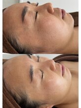 ヨルエステ(yoru aesthe)/【全顔毛穴洗浄×鎮静パック】