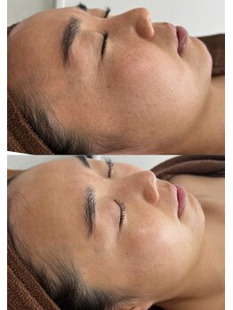 ヨルエステ(yoru aesthe)/【全顔毛穴洗浄×鎮静パック】