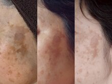 ヒロネイル アンド ビューティーサロン(hironail)の雰囲気（大人気フェイシャル！お肌のお悩みいつでもご相談ください）