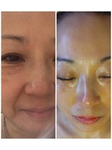 エステティック パルフェ/5年前before→2023年after★