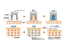 トラレス(Trouless)/脂肪冷却