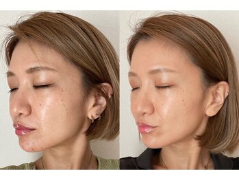 エクレクティック(ECLECTIC)/横顔美人/小顔/老け顔撃退